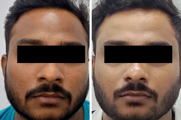 Hydrafacial Treatment